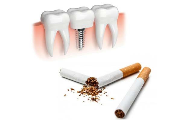 The effect of smoking on dental implants 5